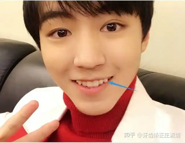 厦门牙齿矫正虎牙不好看为什么不能拔掉