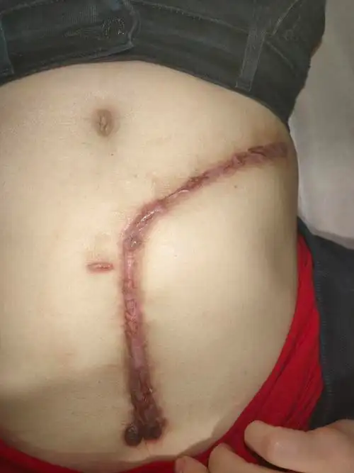 肚子处手术后增生了,感觉是疤痕疙瘩