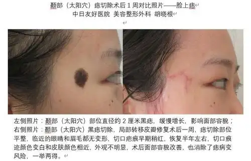 颞部太阳穴痣切除术后1周对比照片048脸上痣