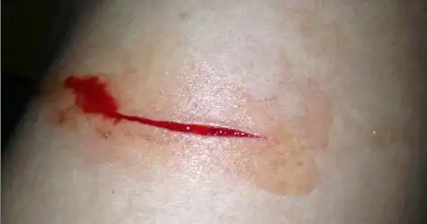 或者这样的情况烧伤七天可手淫不小心出了精子会影响伤口 不知道被