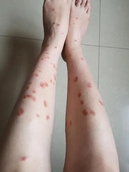 怎么能消掉丘疹性荨麻疹