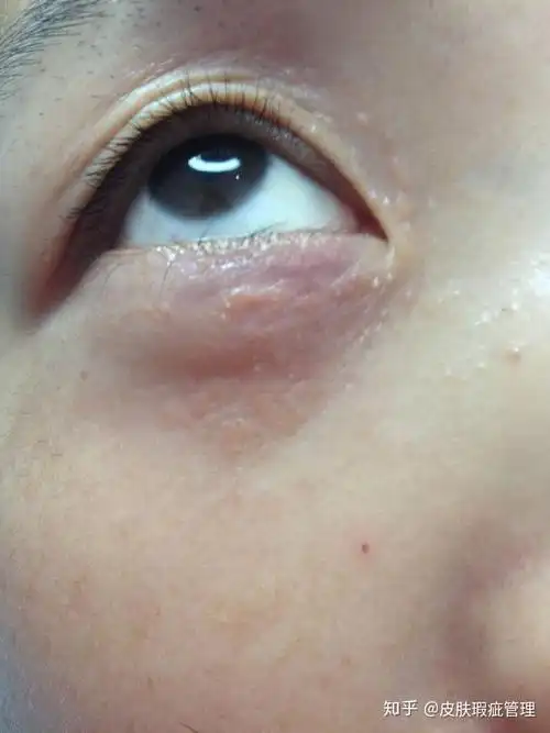 汗管瘤不治疗可自愈吗 - 知乎