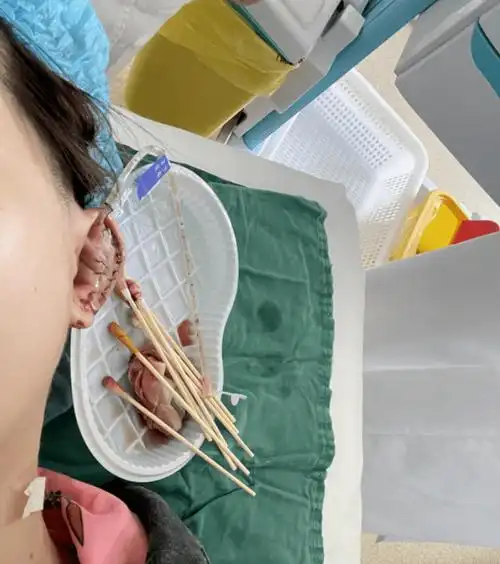 "她的右耳肿得像个饺子,病情非常严重.