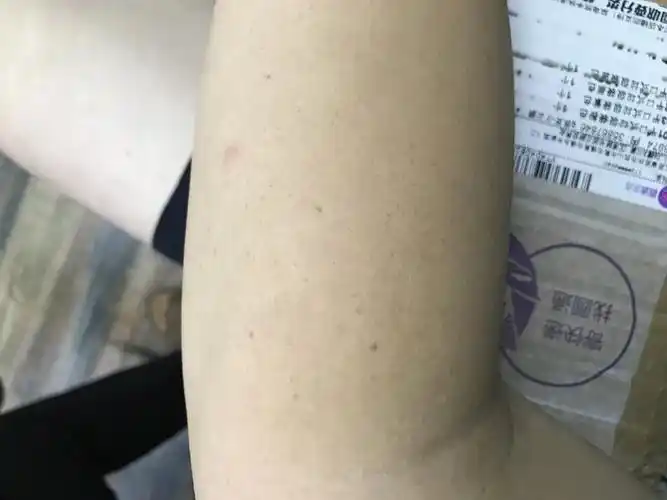 手臂上好多褐色斑点是什么怎么弄