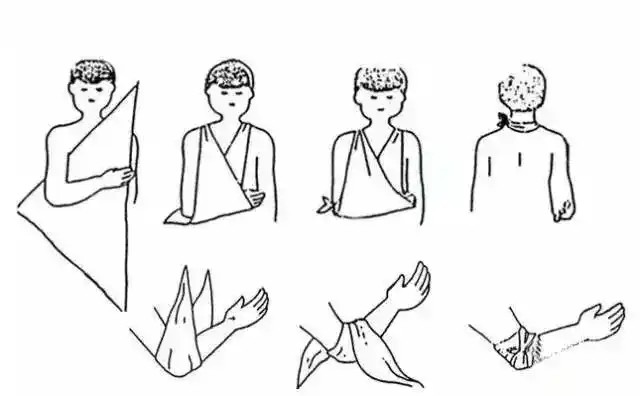 其它 【急救知识】三角巾包扎 写美篇①单眼包扎法:将三角巾折成四指