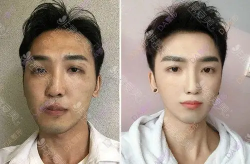 韩国男性轮廓整形案例集锦为什么有人整后像韩星