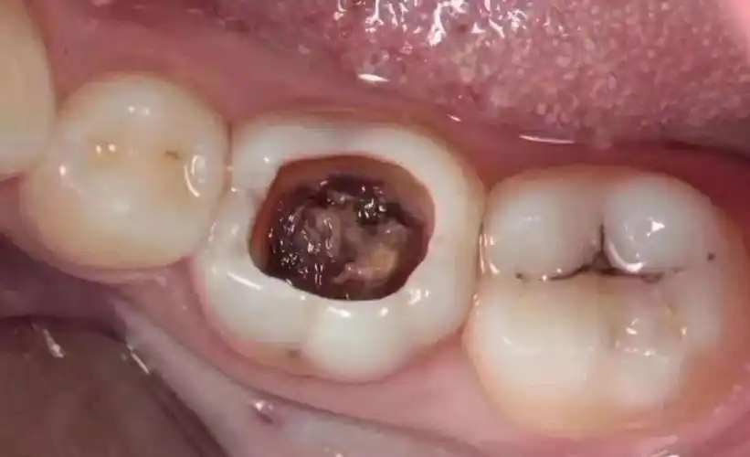 小课堂——虫牙,蛀牙