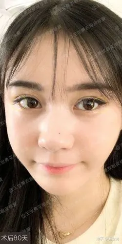 外眼角修复案例分享 | 外眼角开的过大,露红,豁口