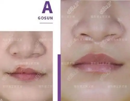 坐诊医生及前后对比图一览,唇裂修复-8682赴韩整形网