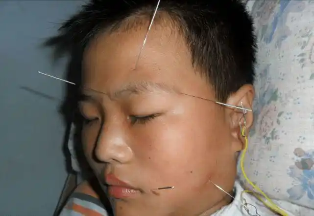 当心空调吹多了会导致面瘫