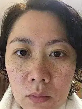 辐射斑能去掉吗( 辐射斑会越来越多吗 )