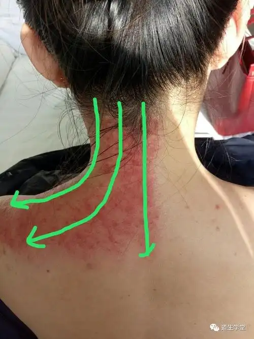 李氏砭法丨刮痧调治项背强几几有感