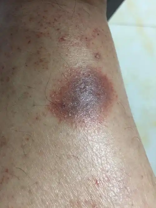 两个脚脖处出现这种斑块情况有谁知道怎么用药?