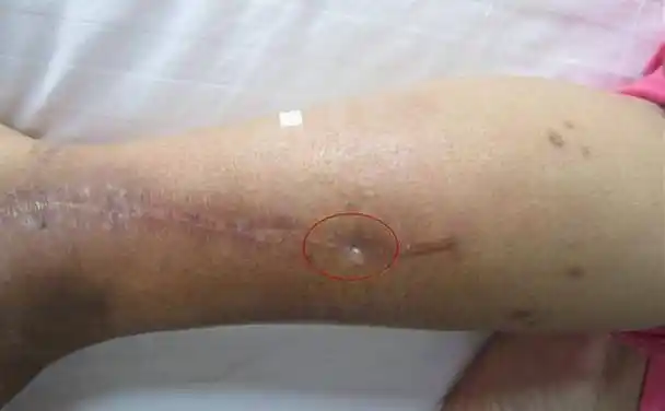 什么是骨髓炎窦道?窦道好了还会发作吗?_治疗_患者_组织