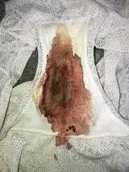 我是试管移植后 第20天 今天早上发现内裤有血正常吗 需要到医院去吗