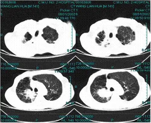 浸润性肺结核表现最多样,最突出的表现就是会产生典型的结核结节及