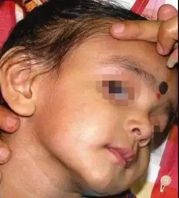 研究显示,医源性库欣综合征在小儿中的发生率多于成人,且导致小儿医源