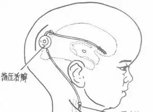 脑积水图片_脑积水症状图片_脑积水图片大全_疾病百科_久久健康网