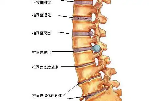 腰椎滑脱如何治疗怎么保守治疗