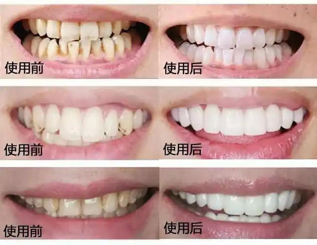 使用一次就能对比得出牙齿变白而且绝对不是靠强摩擦美白,不会损伤牙