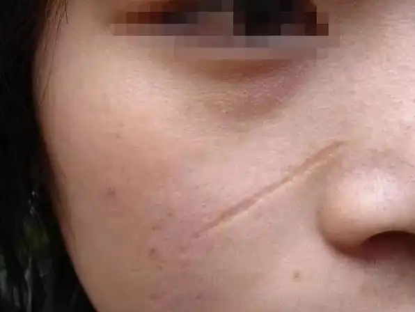 快来看看你的疤痕好治吗