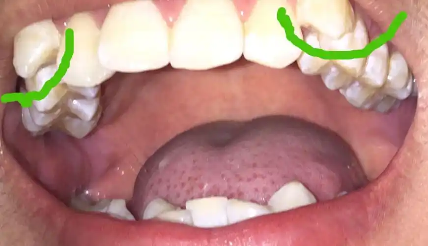 我上面左右有两个牙齿尖尖的