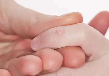 常见皮肤病图片及名称疣