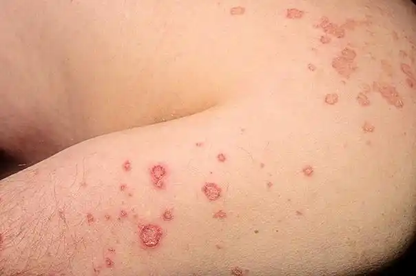 湿疹图片和症状 (16)_有来医生