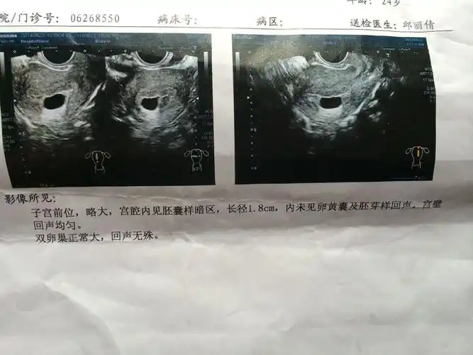 急急急 怀孕53天 b超单如下 有见红 宝宝还有用吗 会不会胎停了