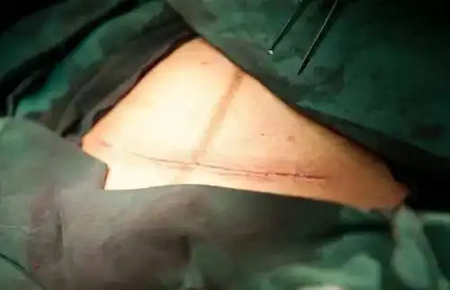 100张剖腹产过程照片,女人真的太伟大了!寿阳男人请疼爱自己的妻子!