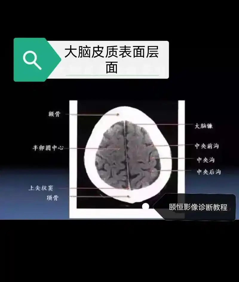 分享干货  想学好颅脑ct诊断,断层解剖是基础,收藏好这十 - 抖音