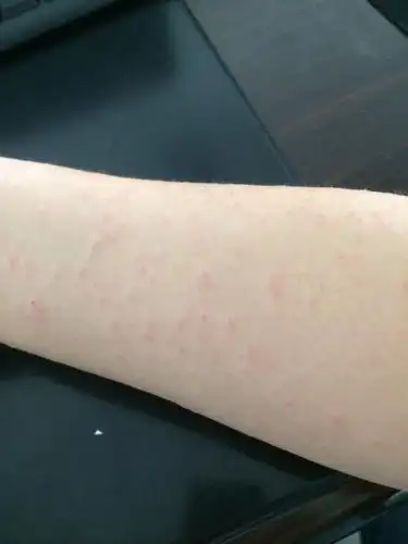 皮肤过敏吗?第一次出现这种情况?怎么治疗?求帮