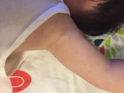 前天开始,低烧,昨天下午然后身上长这种红疹子,本来