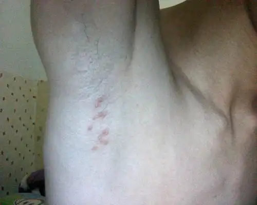 问:前天下午 腋下有10几颗疱疹 又疼又痒 怎么办 会传染么