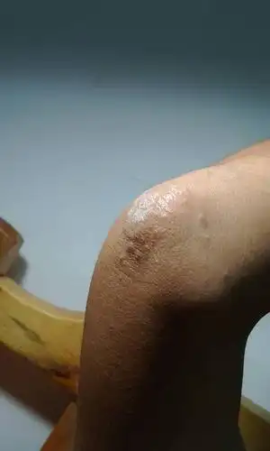 右胳膊肘外部位不定期的起小疙瘩,皮肤增厚,很痒.