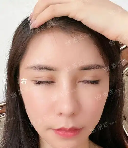 至,开外眼角)虽然火爆,但真心不建议做|下睑|双眼皮|手术|下眼睑_网易