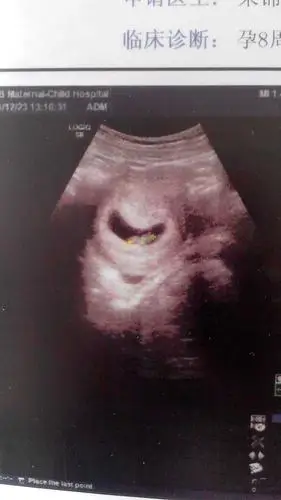 宝妈孕囊跟我这形状一样吗?男孩女孩?