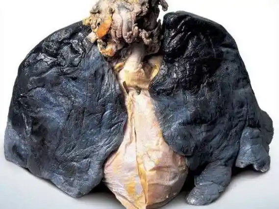 所以呀,不抽烟!