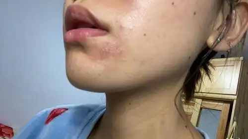 去医院刷酸感觉被烧伤了……有做过的朋友帮忙看下.