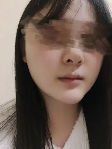 做假体下巴23天了,真的太翘太长了,马_新氧-专业医美服务平台