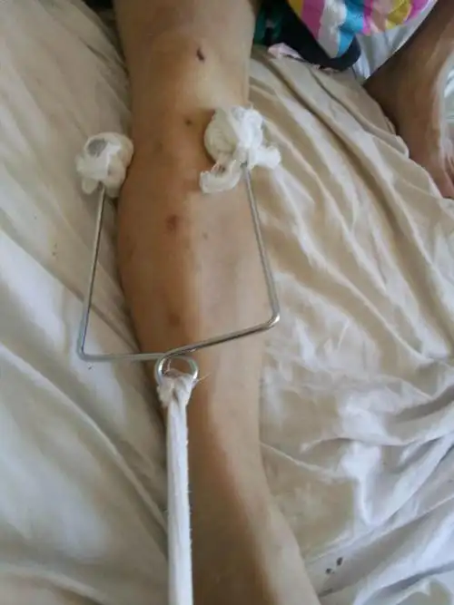 骨科牵引弓多功能床头牵引架 斯氏牵引弓 布朗式架牵引弓骨科器械