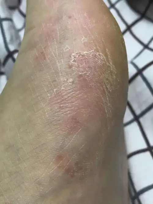 这是啥病,脚掌内测有一块红,里面有好多小疙瘩,但只有一只脚有