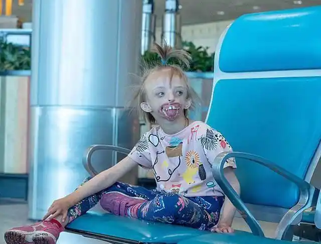 俄罗斯一小女孩,天生没有下巴,不想生出"畸形儿",要注意这些