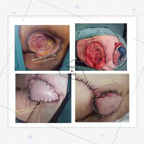 时来运转的美篇——特殊创面的皮瓣修复