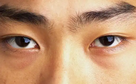 眼白发黄是怎么回事怎样快速变白眼白发黄怎么立马变白图