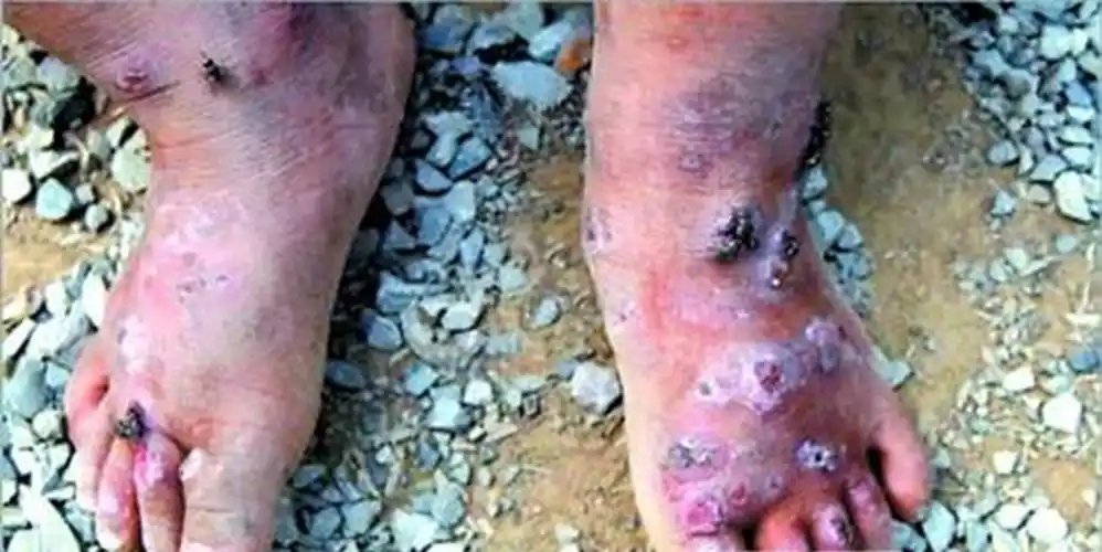 女性艾滋病感染者皮肤