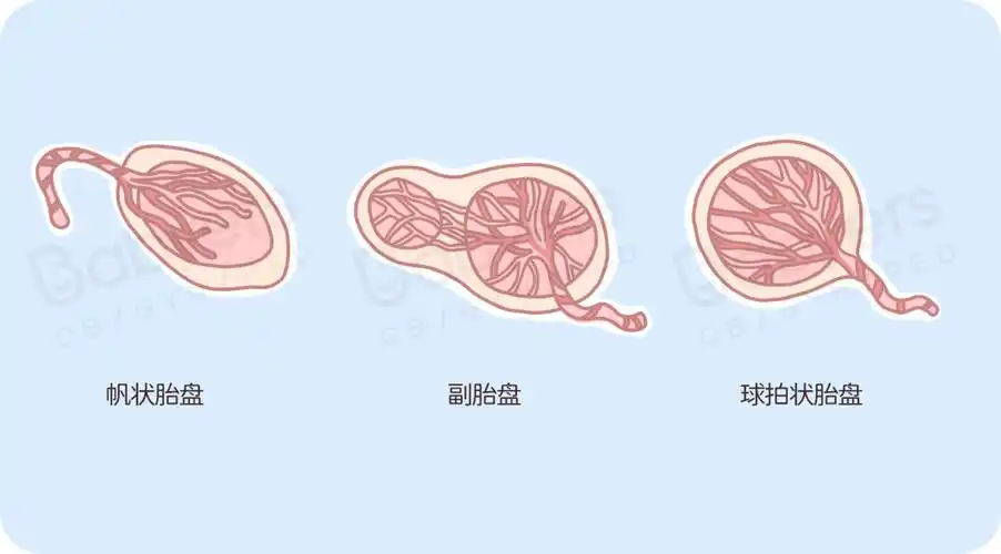 胎盘残留排出图片