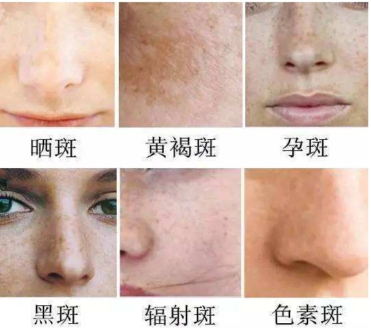 深圳联合丽格王洪军院长:祛斑,你肯定犯过的错!