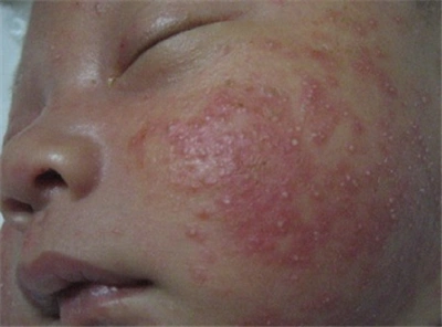 新生儿湿疹的症状_伴有-渗出-湿疹-局部-_新生婴儿_婴童架构_明品生活