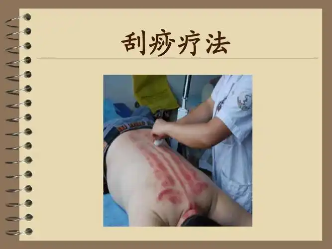 刮痧--曾晓清ppt